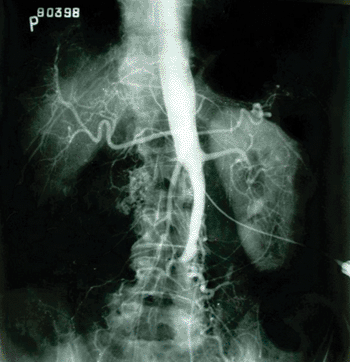 Imagen: Rayos-x del síndrome Leriche, representativo de pacientes con enfermedad oclusiva aortoiliaca (Fotografía cortesía de Wikipedia Commons).